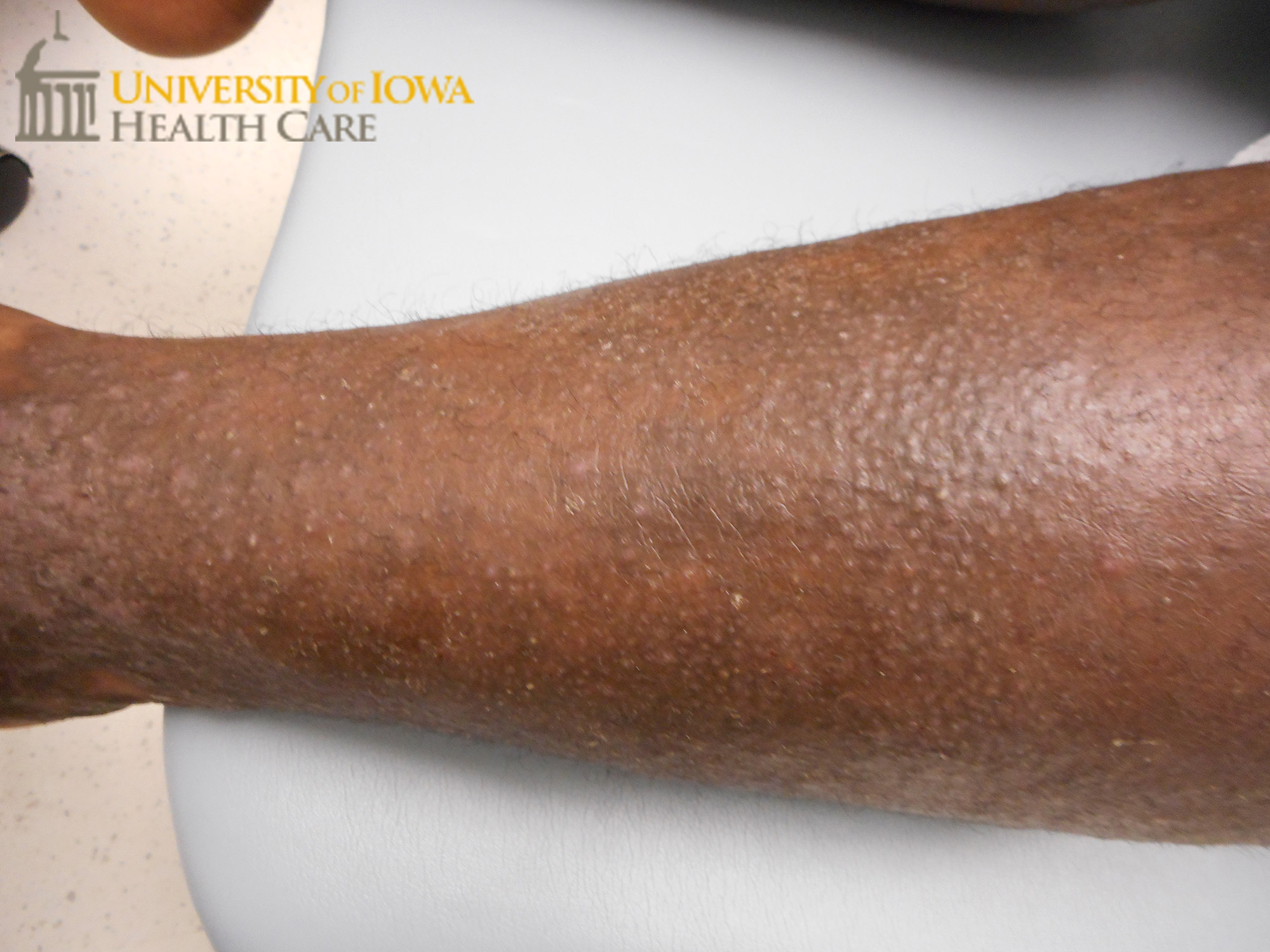 Pinkfolliculocentric papules coalescing into plaques on the lower leg. (click images for higher resolution).